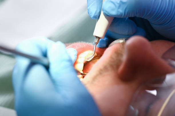 Best Emergency Root Canal Treatment in Tuolumne City, CA